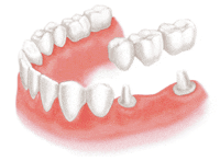 歯を一本失った場合のブリッジ治療
