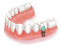 歯を一本失った場合のインプラント治療