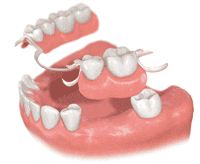 歯を数本失った場合のブリッジ治療