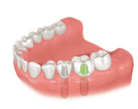 歯を数本失った場合のインプラント治療