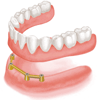 歯を全て失った場合のインプラント治療